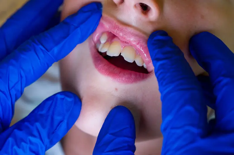 ICD-10 Codes for Coding a Common Dental Condition – Hyperdontia