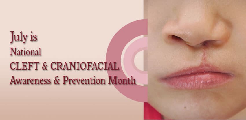 July is National Clef and Craniofacia awareness and Prevention