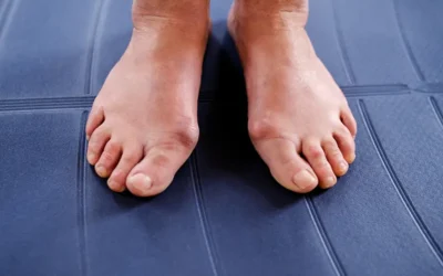 Coding for Bunionectomy, a Common Foot and Bone Surgical Procedure