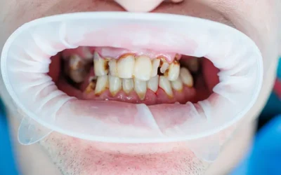 How to Code for Dental Caries Using ICD-10 Medical Codes