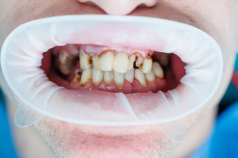 How to Code for Dental Caries Using ICD-10 Medical Codes