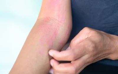 ICD-10-CM Coding For Certain Warm Weather Diseases