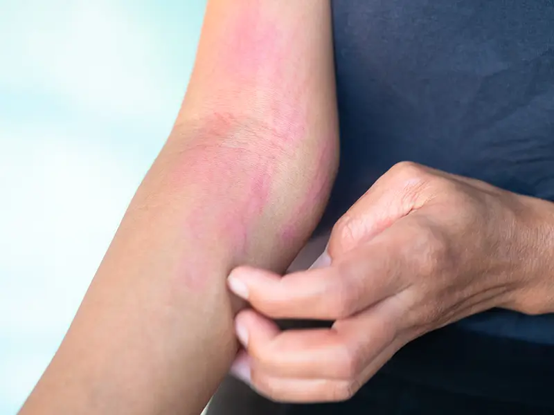 ICD-10-CM Coding For Certain Warm Weather Diseases