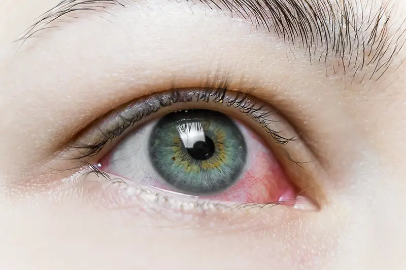 ICD-10 Codes for Reporting Uveitis