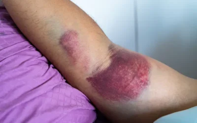 ICD-10 Codes for Reporting Different Soft-tissue Injuries