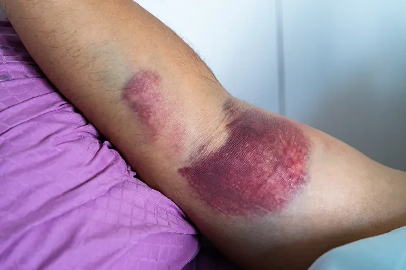 Reporting Different Soft-tissue Injuries