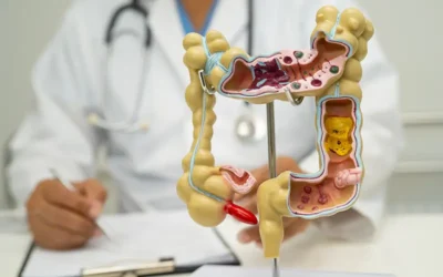 Diverticular Disease – Risk Factors, Symptoms, and ICD-10 Codes