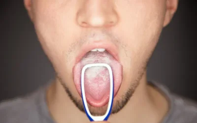 Documenting and Coding Leukoplakia – A Common Mouth Condition