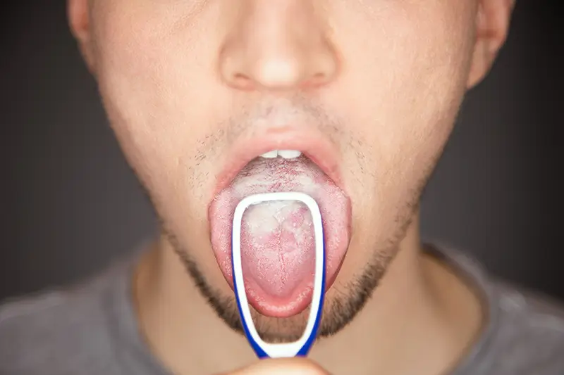 Documenting and Coding Leukoplakia - A Common Mouth Condition