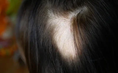 Reporting Alopecia Areata using ICD -10 Codes