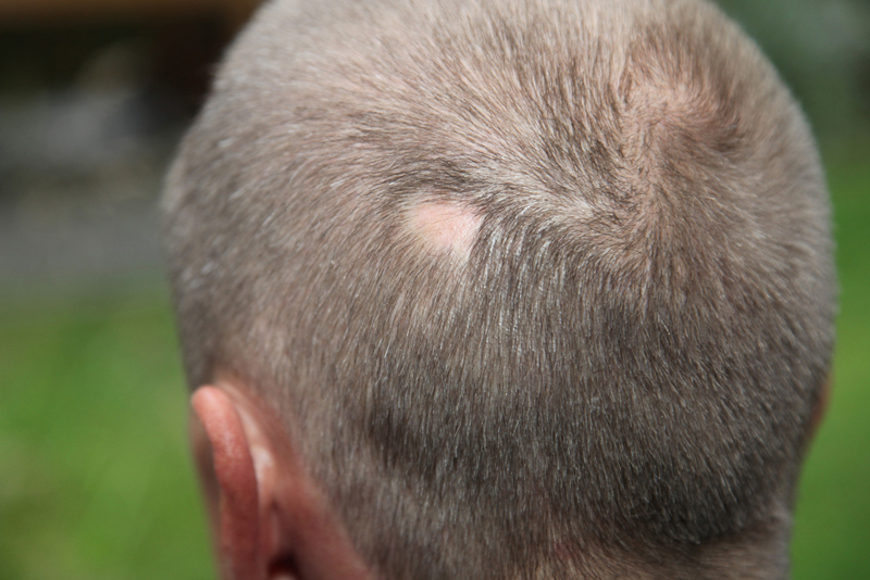 Reporting Alopecia Areata using ICD -10 Codes