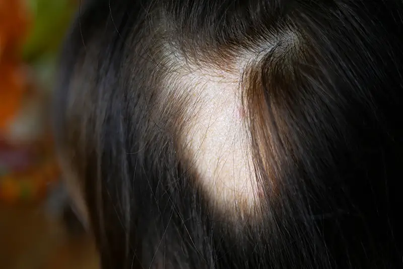 Reporting Alopecia Areata using ICD -10 Codes