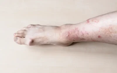 Six Common Diabetes-related Skin Disorders & Their ICD-10 Codes
