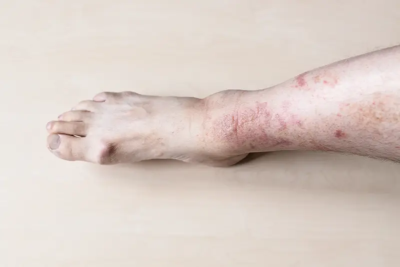 Diabetes-related Skin Disorders & Their ICD-10 Codes Six Common Diabetes-related Skin Disorders & Their ICD-10 Codes