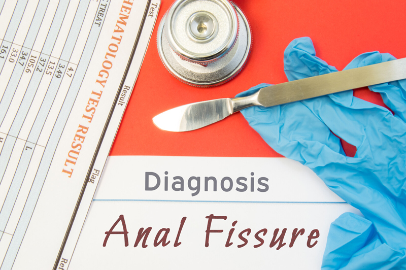 Questions and Answers about Anal Fissure