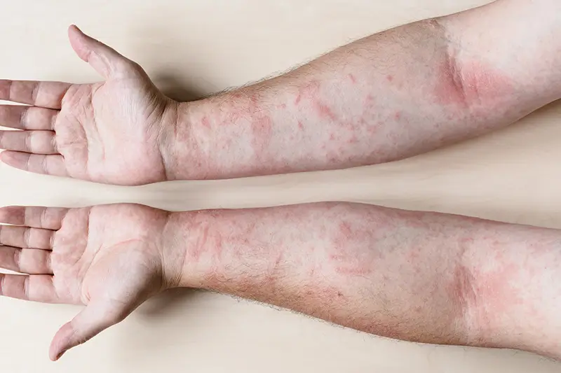 Six Common Diabetes Related Skin Disorders ICD-10 Codes Six Common Diabetes Related Skin Disorders Their ICD-10 Codes
