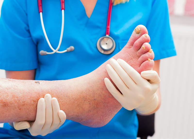 Diagnosing and Documenting Charcot’s Foot – An Overview