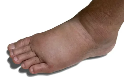 Diagnosing and Documenting Charcot’s Foot – An Overview