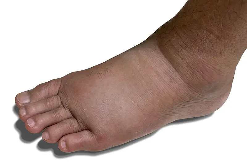 Diagnosing and Documenting Charcot’s Foot – An Overview