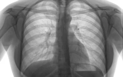 ICD-10 Codes to Document Pneumothorax – A Common Lung Condition