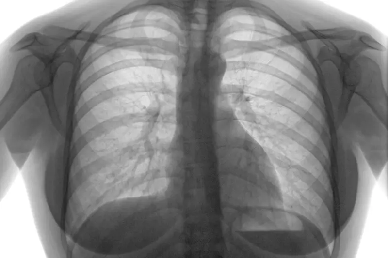 ICD-10 Codes to Document Pneumothorax – A Common Lung Condition