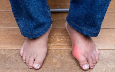 Documenting Gout – Symptoms, Diagnosis and ICD-10 Codes