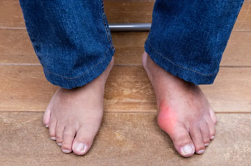 Documenting Gout - Symptoms, Diagnosis and ICD-10 Codes