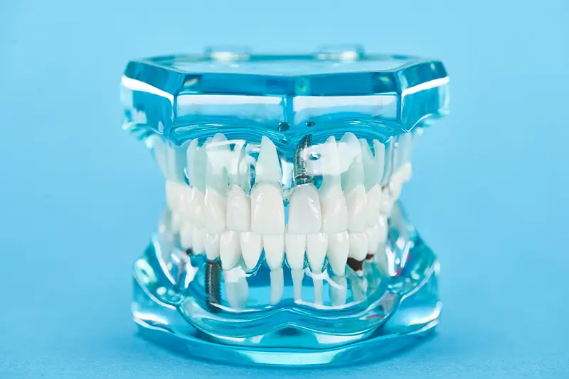 Why Does “D2950” Dental Core Buildup Code Face More Claim Denials?