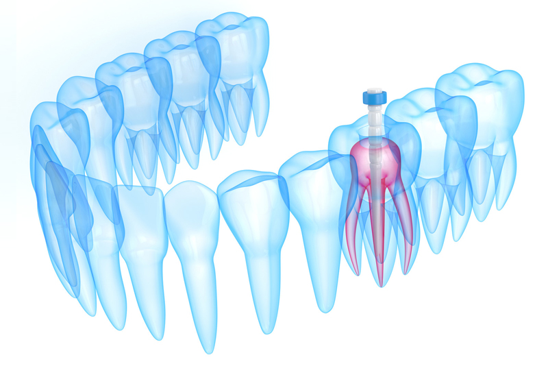 Dental Core Buildup Code