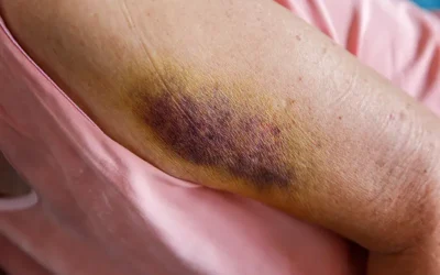 ICD-10 Codes and Guidelines for Reporting Deep Pressure-Induced Tissue Damage in 2020