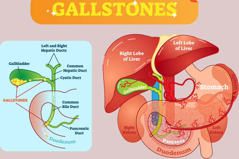 Coding Gall Stones – An Overview of the Symptoms and Treatment