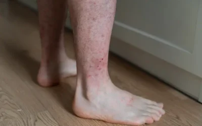Coding Vasculitis, a Common Autoimmune Disease in ICD-10