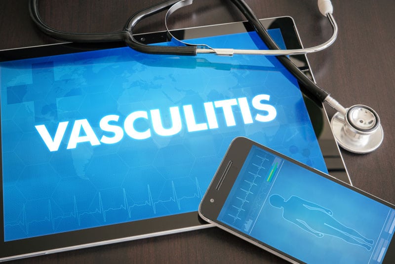 Coding Vasculitis, a Common Autoimmune Disease in ICD-10