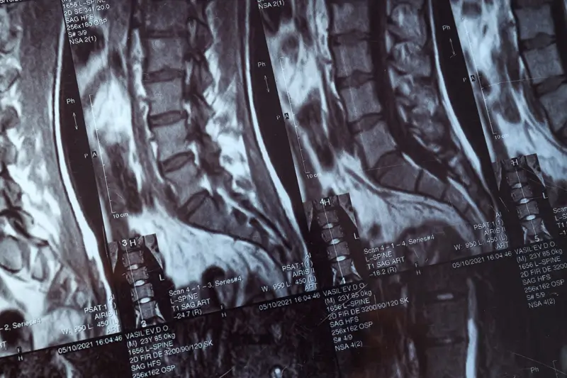 Documenting Syringomyelia – A Chronic Neurological Disorder