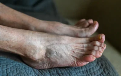 ICD-10 Codes for Common Foot Problems Affecting the Elderly