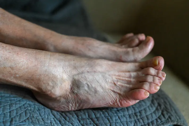 ICD-10 Codes for Common Foot Problems Affecting the Elderly