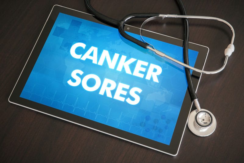 Billing and Coding Canker Sores, a Common Oral Condition