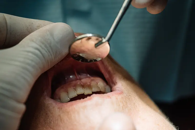 How to Code Gum Recession in Dental Billing