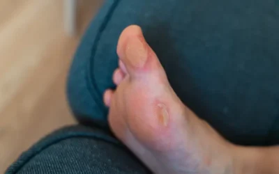 ICD-10 Diagnosis Codes for Reporting Arterial Ulcers