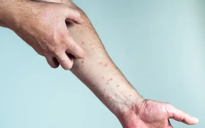 ICD-10 Diagnosis Codes for Three Major Allergic Conditions