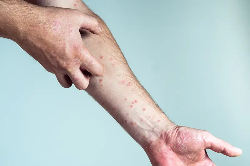ICD-10 Diagnosis Codes for Three Major Allergic Conditions