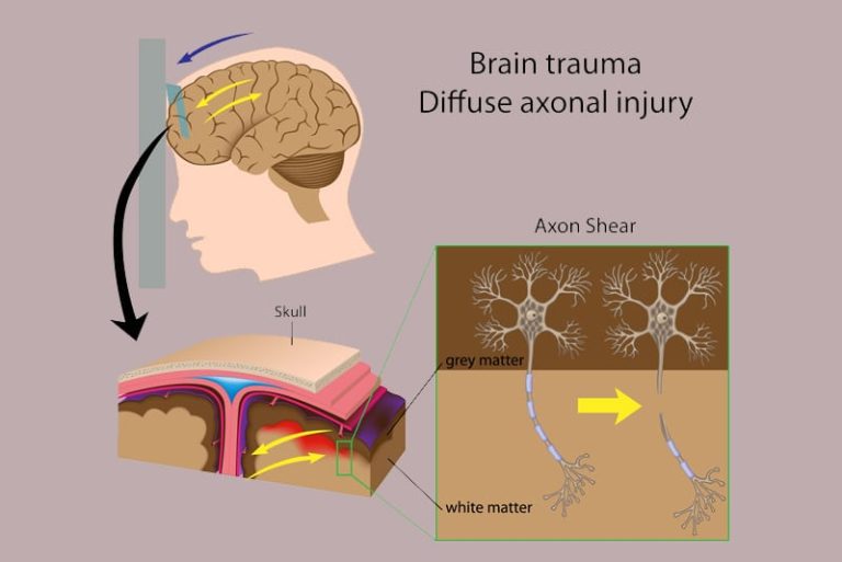 Coding Diffuse Axonal Injury A Common Traumatic Brain Injury