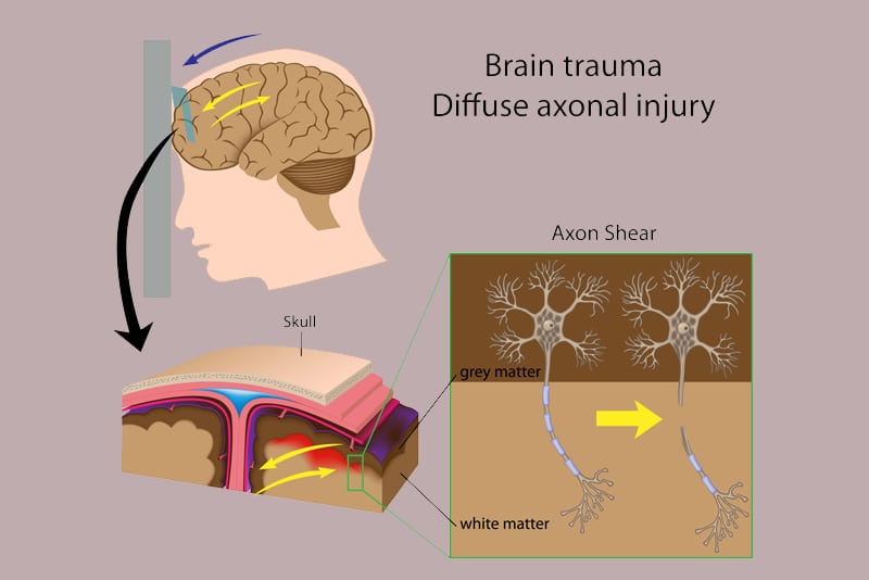 Coding Diffuse Axonal Injury - A Common Traumatic Brain Injury