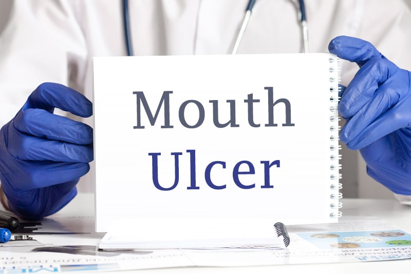 Mouth Ulcer