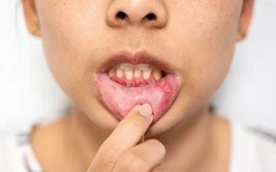 Documenting and Coding Oral Mucositis – A Painful Mouth Ulcer Condition