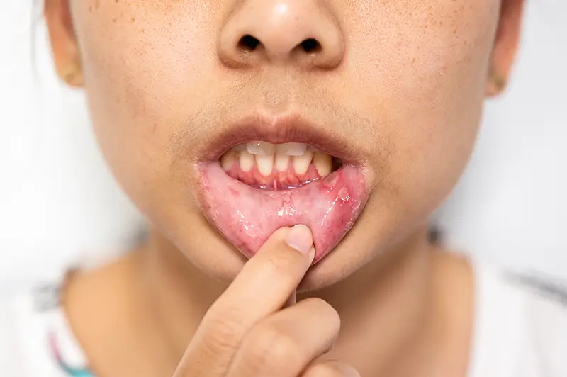 Documenting and Coding Oral Mucositis – A Painful Mouth Ulcer Condition