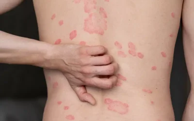 New ICD-10 Code to report Multisystem Inflammatory Syndrome (MIS) in 2021
