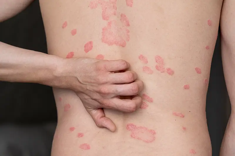 New ICD-10 Code to report Multisystem Inflammatory Syndrome (MIS) in 2021