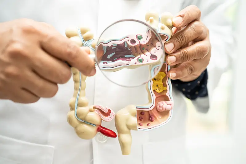Colon Polyps – Diagnosis and ICD-10 Coding