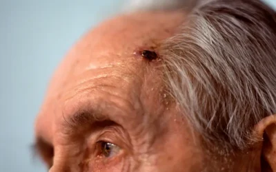 What are the ICD-10 Codes for Merkel Cell Carcinoma?